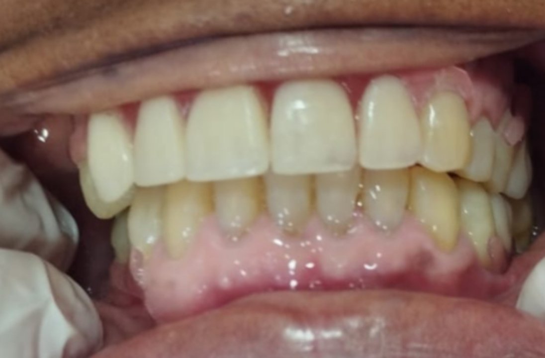 Resultado dental final del caso clínico 01