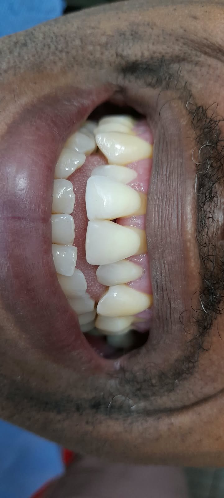 Vista dental inicial del caso clínico 02